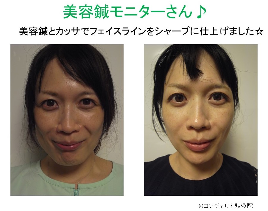 美容鍼モニターの写真 練馬区氷川台のコンチェルト鍼灸院 美容鍼モニターの写真 練馬区氷川台のコンチェルト鍼灸院